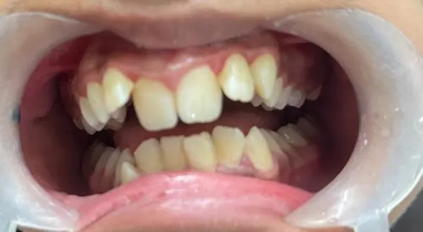 Crowded front teeth before braces