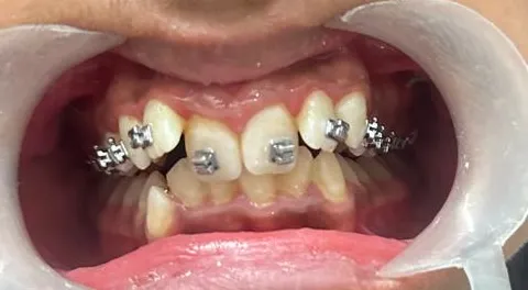 The same teeth with metal braces fitted