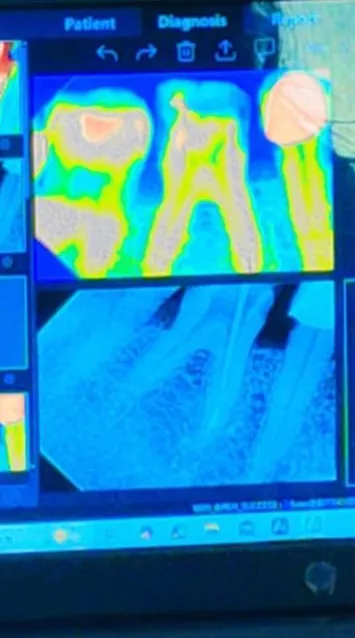 X-ray checked before a tooth extraction