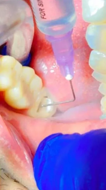 Cleaning the root canal with an irrigation syringe