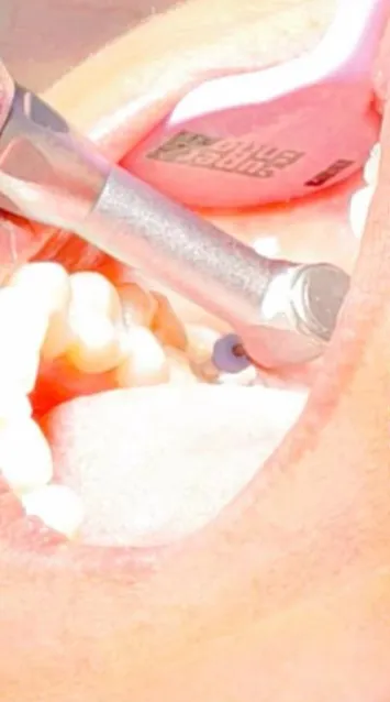 Rotary root canal instrument in use