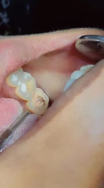 Close-up of a cavity in a back tooth before filling